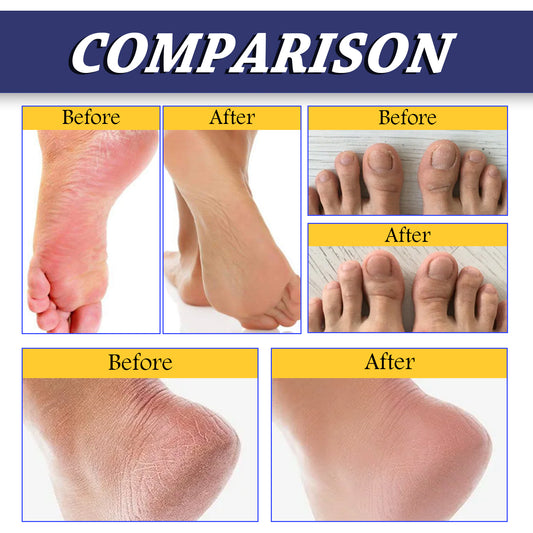 South Moon Urea Hand And Foot Cream, Anti-Crack Peeling Repair Skin Crack Dry Moisturizing Skin Soothes Skin
